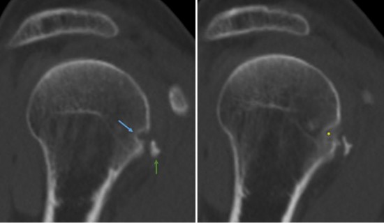 Le  scanner réalisé confirme le diagnostic évoqué à l’IRM. Il retrouve l’érosion corticale du tubercule mineur (flèche bleue) en regard de la calcification tendineuse du chef inférieur du subscapulaire (flèche verte). Notez l’aspect flou et floconneux de la calcification au sein de l’érosion (astérisque jaune) témoin du processus de résorption en cours. 
